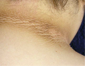 acanthosis nigricans