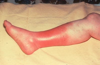 cellulitis_leg.jpg