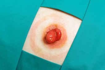 peroperative ostomy siting