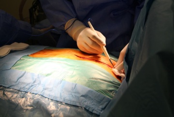 surgical site infection prevention