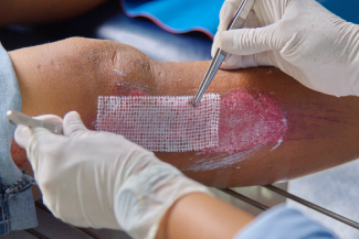 Wound bed preparation