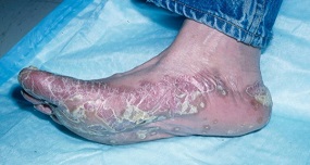 hyperkeratosis-2.jpg