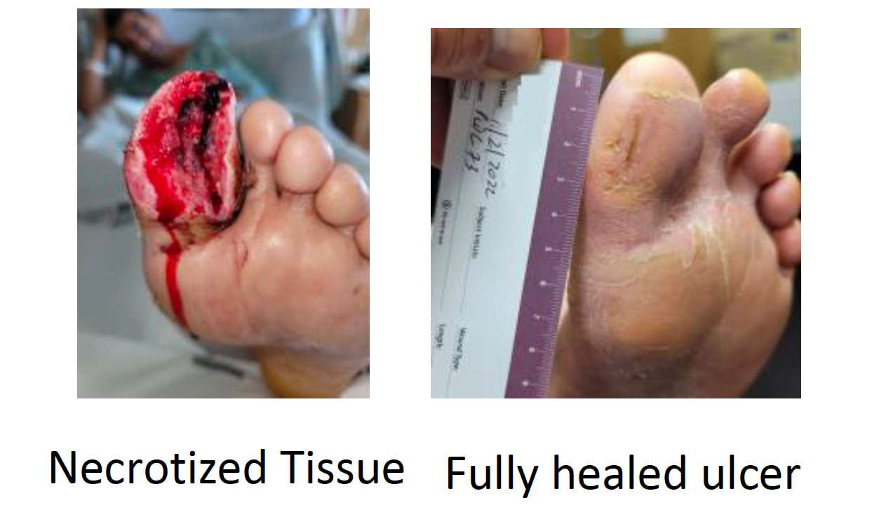 Diabetic foot ulcer