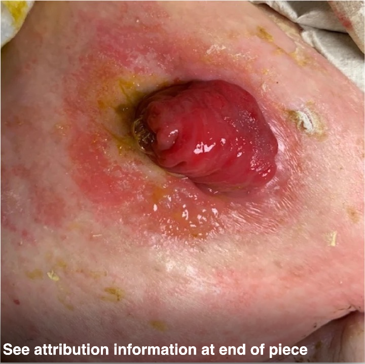 Peristomal Irritant Contact Dermatitis