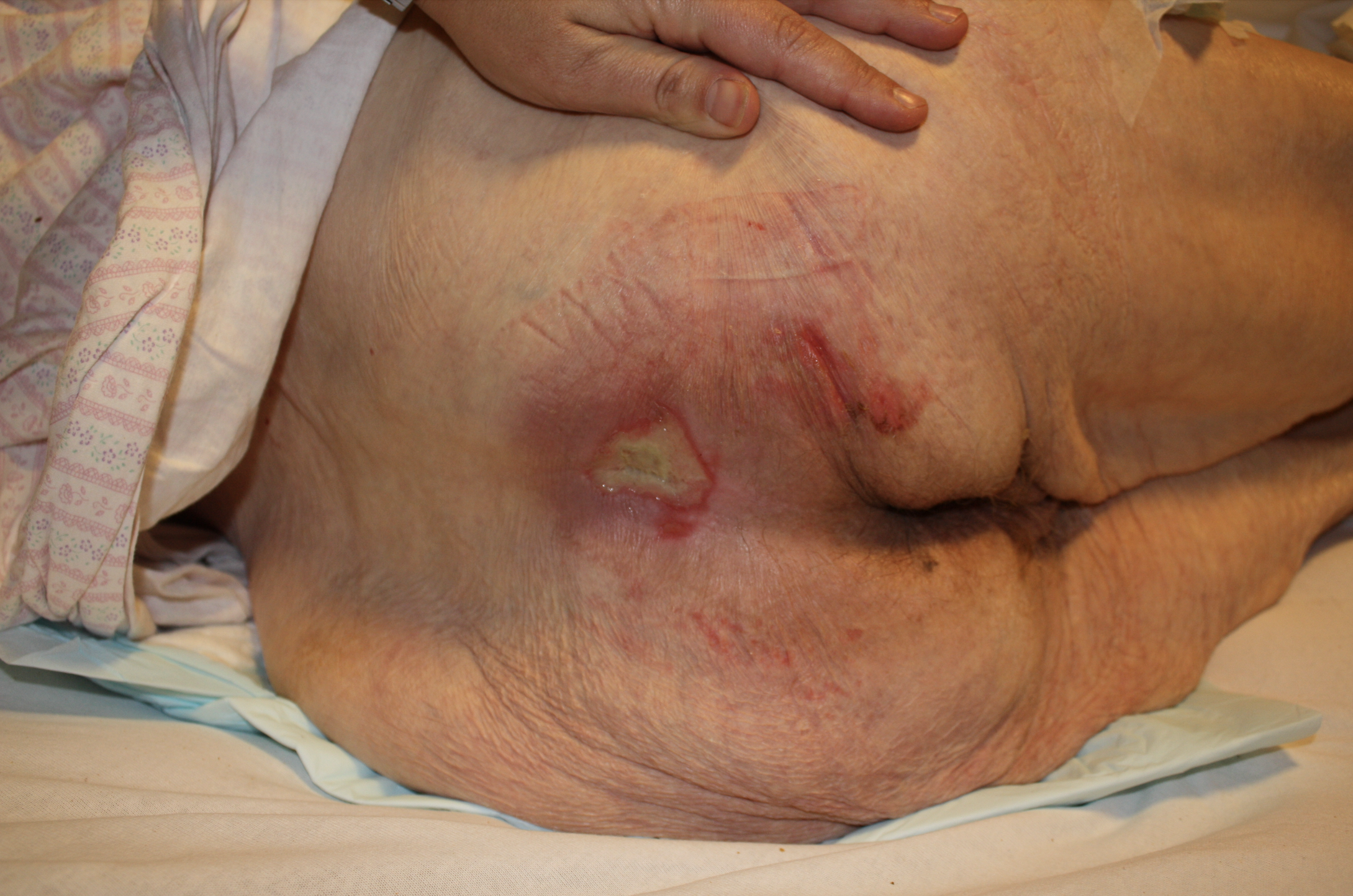 Pressure Ulcer on Sacrum