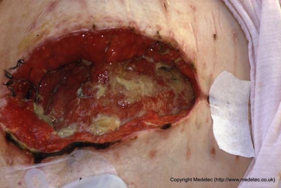 Dehisced surgical wound