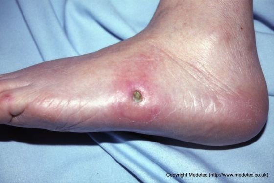 Diabetic Foot Ulcer