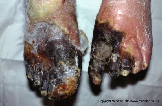 Ischemic Disease, Necrotic Tissue