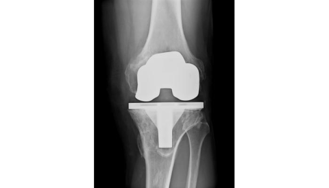 Knee replacement