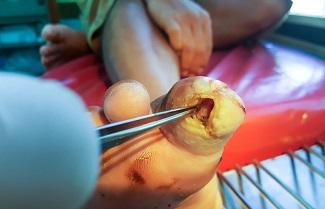 Debridement