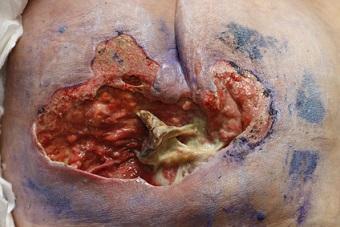 Sacral wound