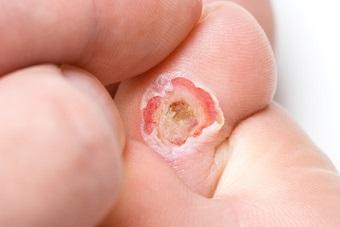 Wound Tissue